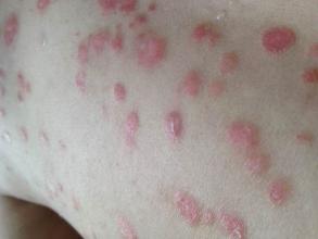 男性銀屑病（牛皮癬）常用外用藥全解析