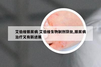 艾伯維生物制劑獲批，銀屑病治療迎來(lái)新突破