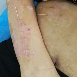 一根火針點(diǎn)燃三十年牛皮癬患者的希望