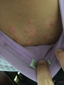 牛皮癬 不只是皮膚上的“癬”，更需科學(xué)認(rèn)知與規(guī)范治療