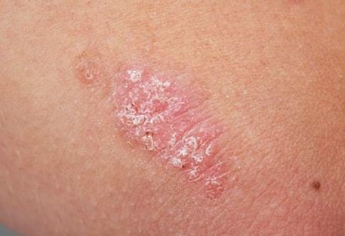 牛皮癬的“消失”與緩解 如何科學(xué)判斷銀屑病進(jìn)程