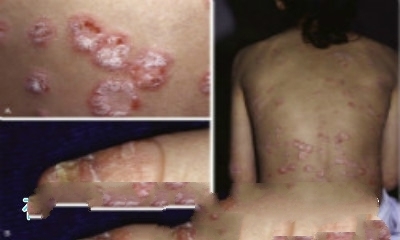 銀屑病治療前后對(duì)比 正確認(rèn)識(shí)牛皮癬的改善與康復(fù)