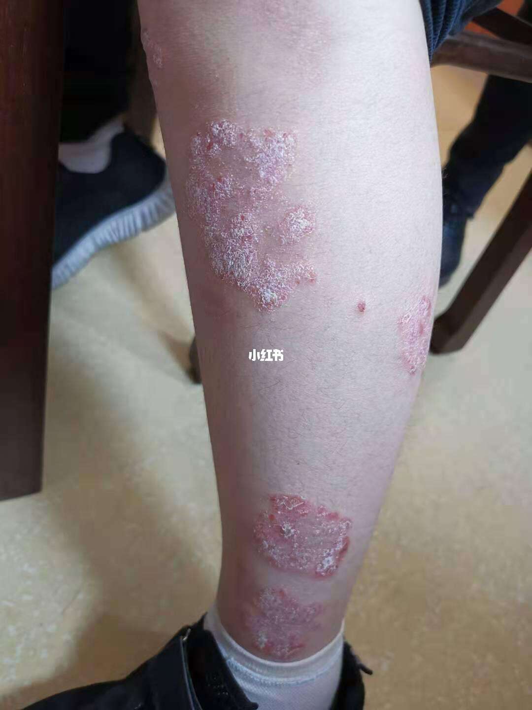 牛皮癬的病程演變 從初期征兆到后期形態(tài)的詳細(xì)對(duì)比