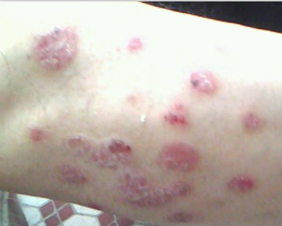 北京銀屑病權(quán)威診療機(jī)構(gòu)推薦與就醫(yī)指南